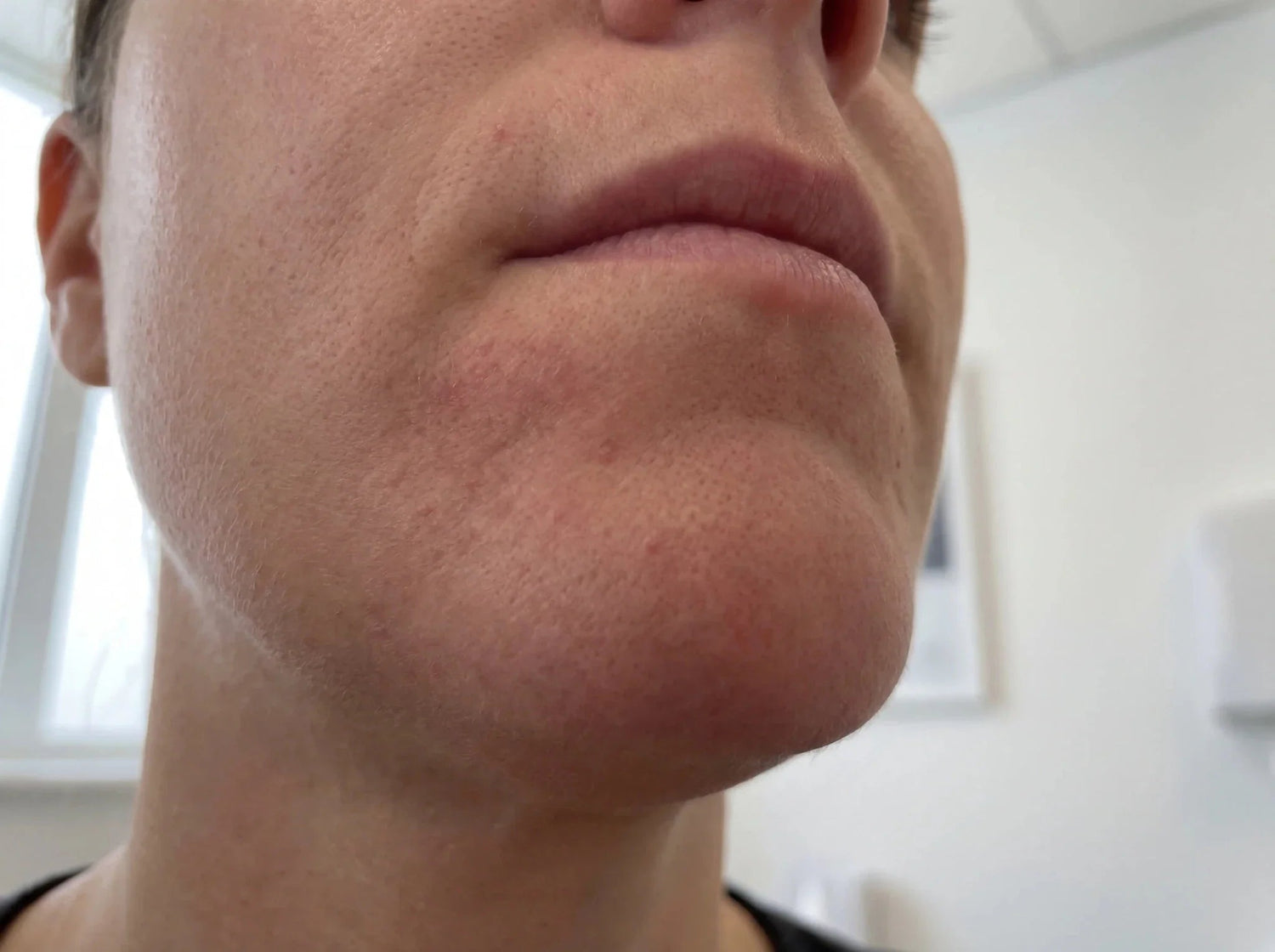 Perioral dermatitis og stress: Derfor trigger stress dine udbrud - NIMO SKIN