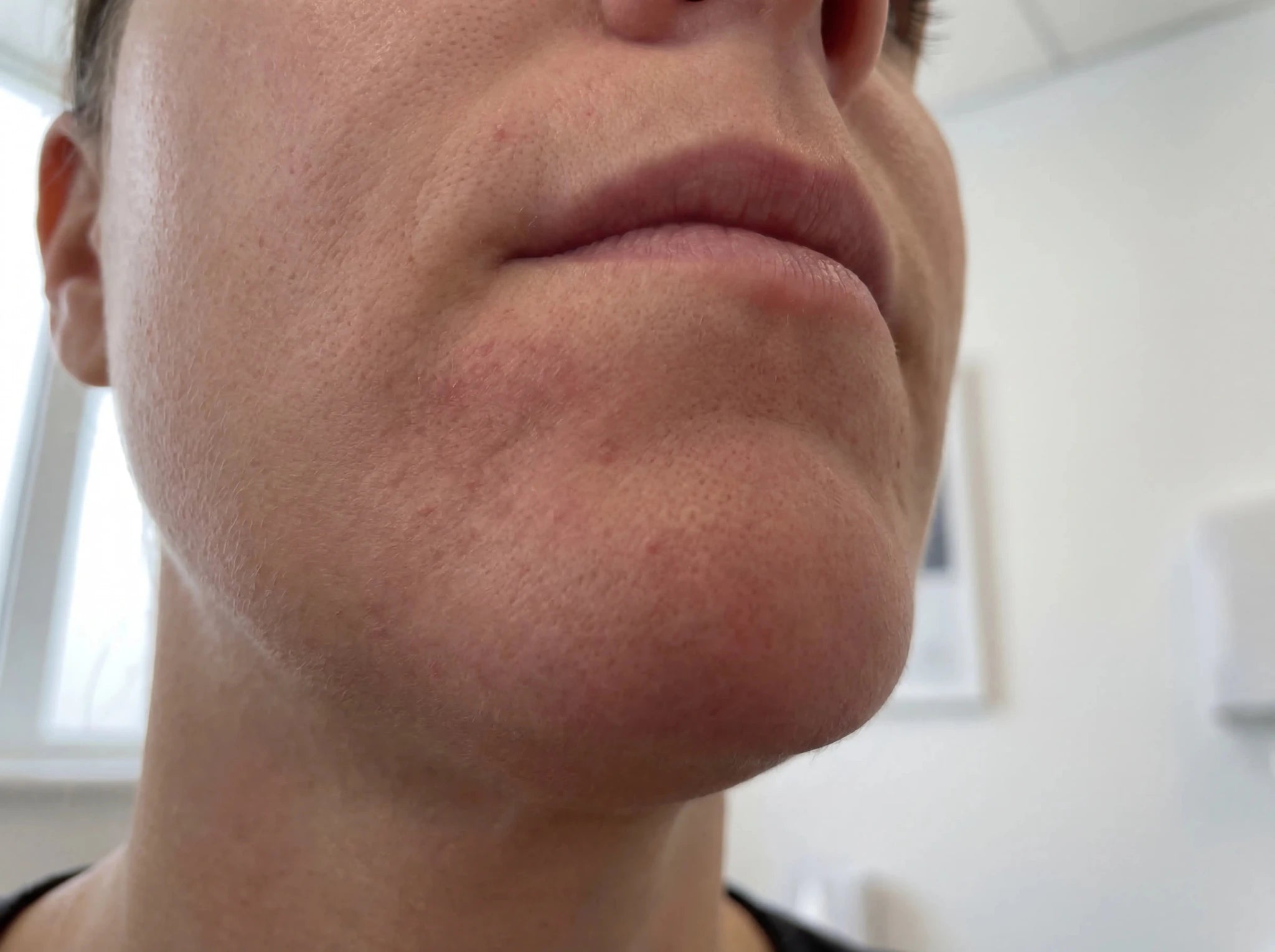 Perioral dermatitis og stress: Derfor trigger stress dine udbrud - NIMO SKIN