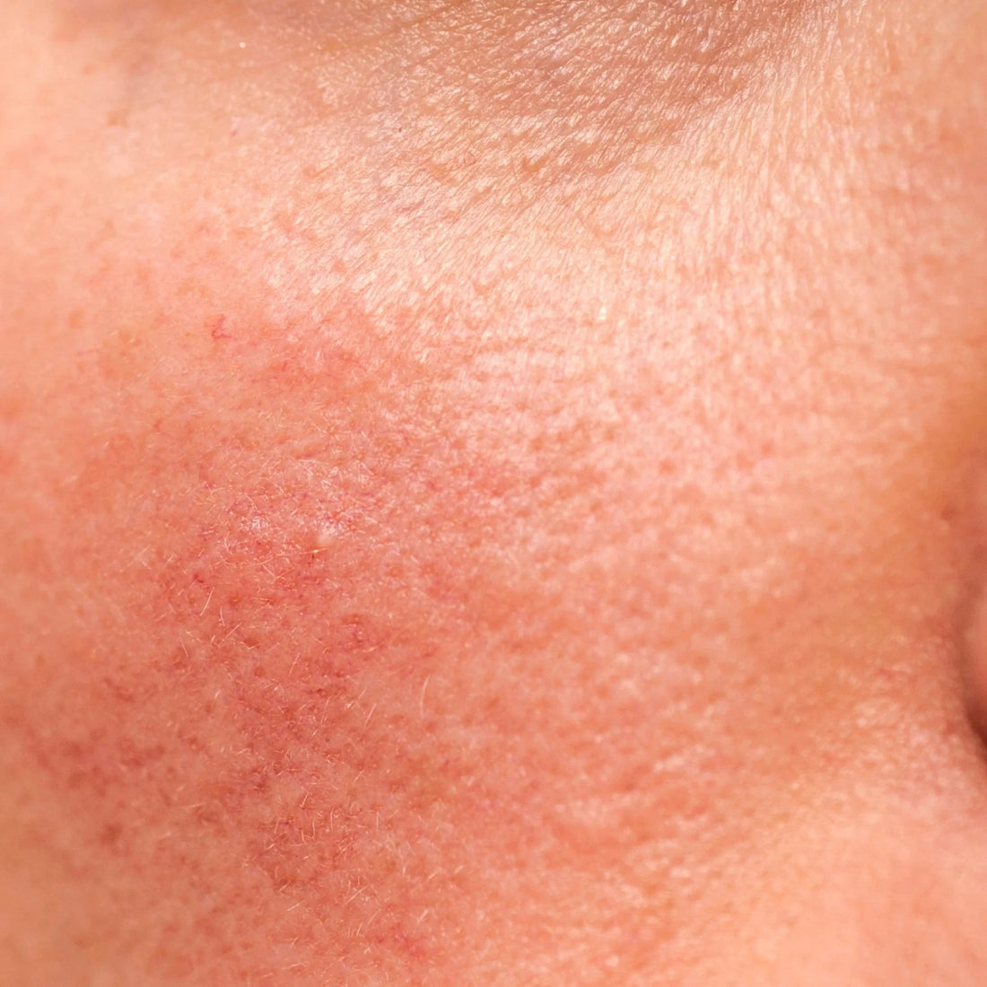 Rundt Om Rosacea: En hurtig oversigt over de oftest stillede spørgsmål - NIMO SKIN