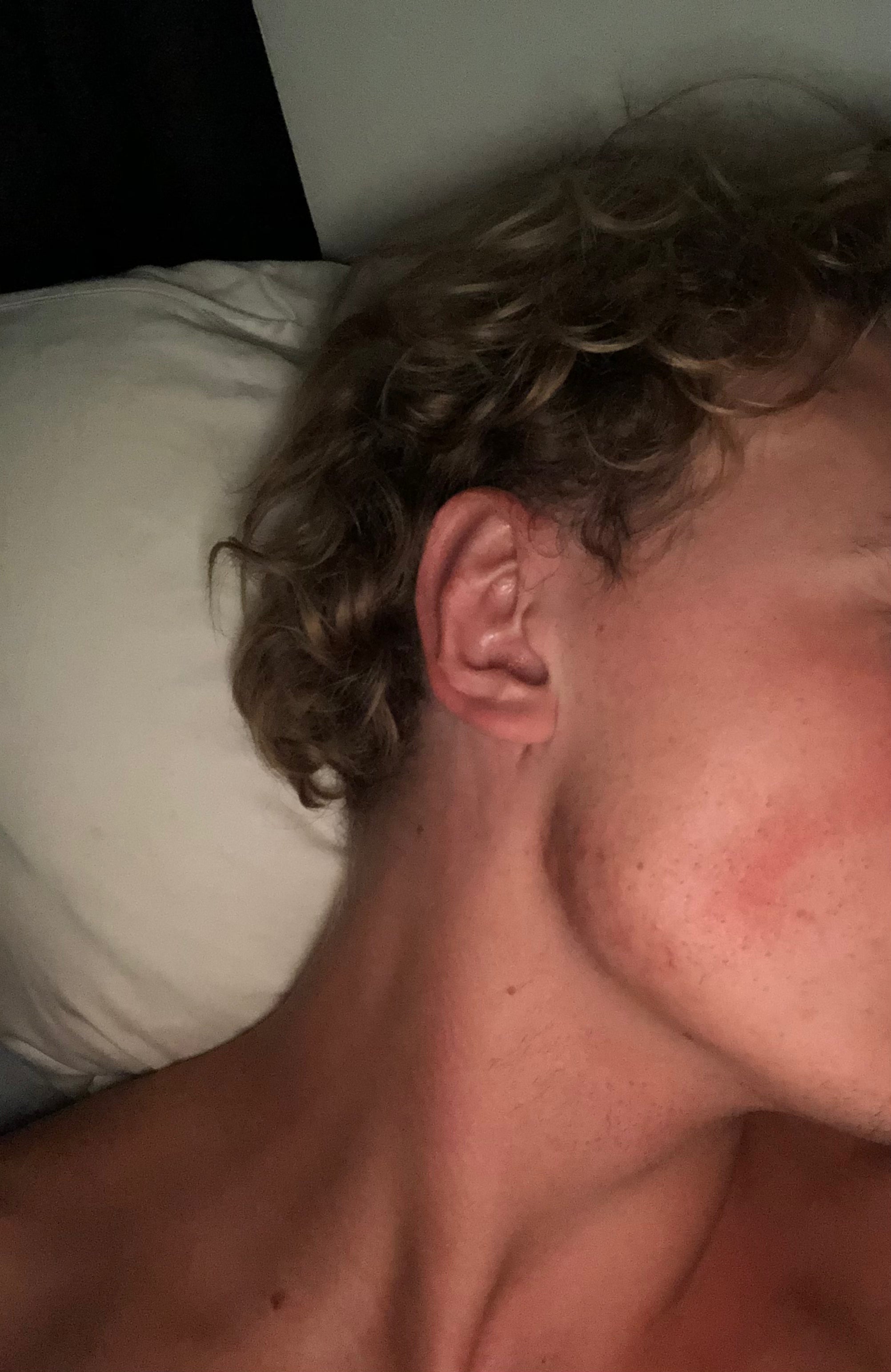 Akne på kæbe hos ung mand